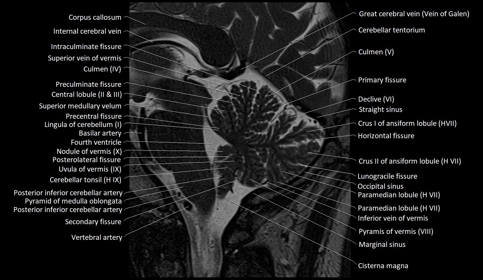 MRI Cerebellar anatomy sagittal High-resolution labelled image 31.webp